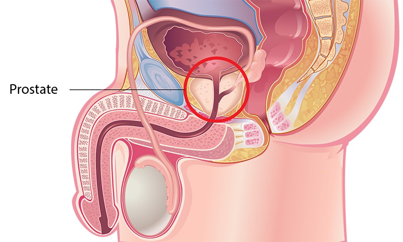 Benign Prostatic Hyperplasia