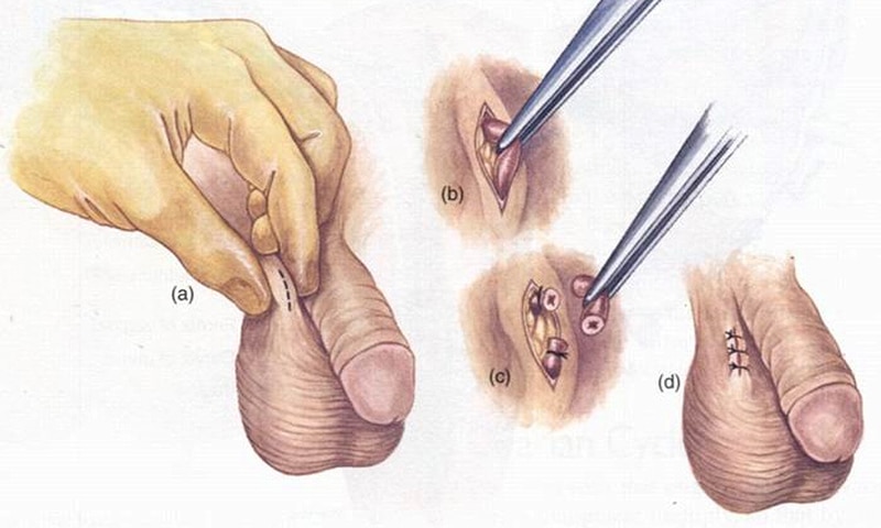 Vasectomy