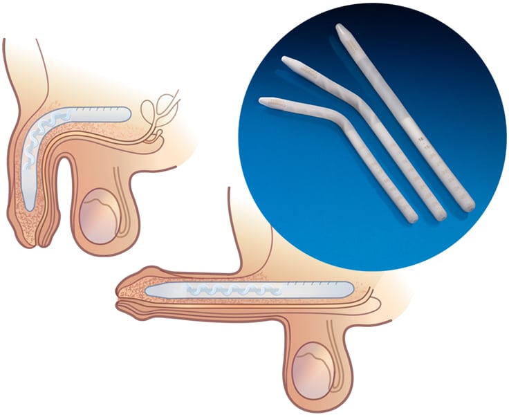 Penile Prosthesis