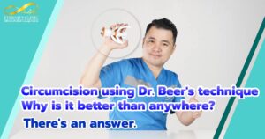 circumcision using Dr.Beer technique