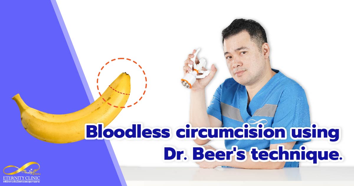 Bloodless circumcision Dr.Beer technique - ETERNITY CLINIC by M.D. SUEBPONG ENGCHUAN Bloodless circumcision Dr.Beer technique