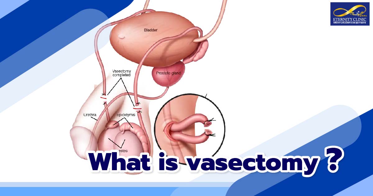 what is vasectomy - ETERNITY CLINIC by M.D. SUEBPONG ENGCHUAN what is vasectomy?