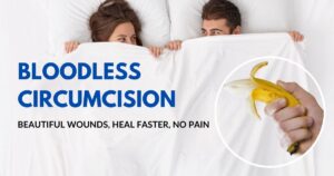 Bloodless circumcision