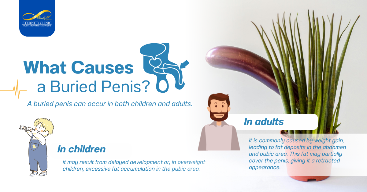 Buried Penis2 - ETERNITY CLINIC by M.D. SUEBPONG ENGCHUAN What Causes a Buried Penis?